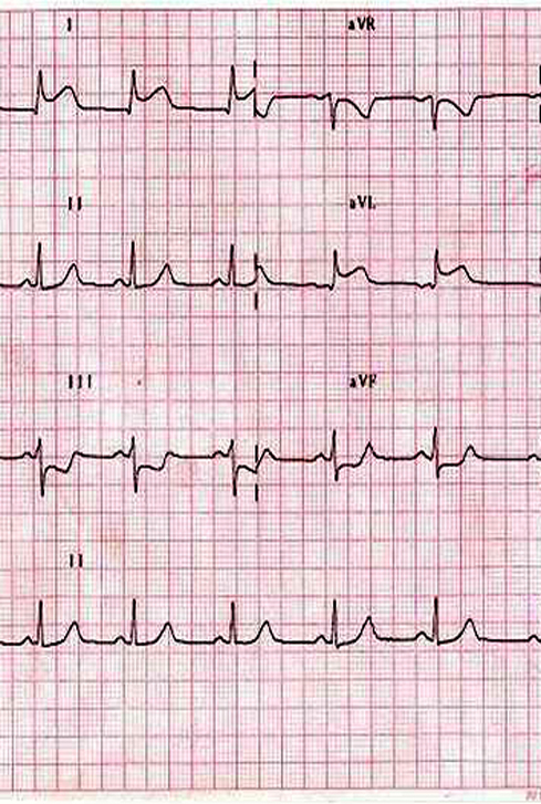 elektrokardiogram